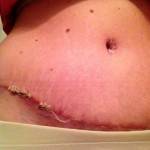 Pictures of tummy tuck (16)
