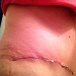 Pictures of tummy tuck (17)