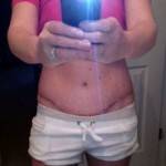Pictures of tummy tuck (19)