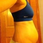 Pictures of tummy tuck (24)