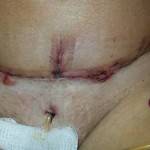 Pictures of tummy tuck (28)