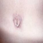 Pictures of tummy tuck (3)