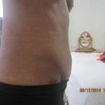 Pictures of tummy tuck (34)