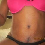Pictures of tummy tuck (38)