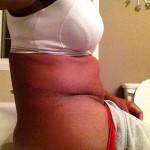Pictures of tummy tuck (43)