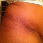 Pictures of tummy tuck (44)