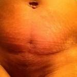Pictures of tummy tuck (45)