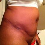 Pictures of tummy tuck (46)