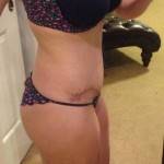 Pictures of tummy tuck (47)