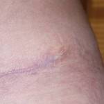 Pictures of tummy tuck (5)