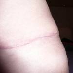 Pictures of tummy tuck (6)