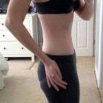 Pictures of tummy tuck (7)
