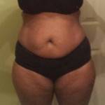 Pictures of tummy tuck before surgery