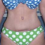 Pictures of tummy tuck operation