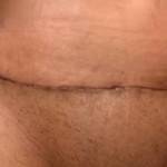 Pictures of tummy tuck scar