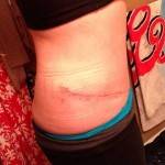 Pictures of tummy tuck scar of patient