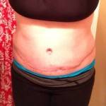 Pictures of tummy tuck scar on belly