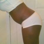 Pictures of tummy tuck stretch marks