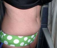 Pictures of tummy tuck surgery