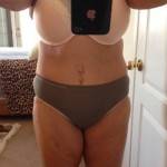 Pictures of tummy tuck vertical scar