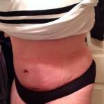 Pictures scars of tummy tuck
