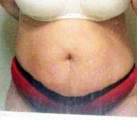 Tummy tuck exercises after pregnancy image