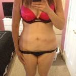 Tummy tuck operation results pictures
