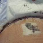 Tummy tuck pics 3 days after surgery