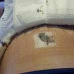 Tummy tuck pics after 3 days