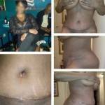 Tummy tuck pics before and after