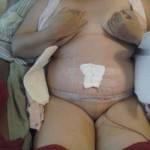 Tummy tuck pics recovery after surgery