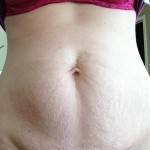 Tummy tuck pics skin after pregnancy