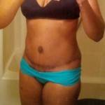 Tummy tuck results pictures (58)