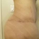 Tummy tuck results pictures full