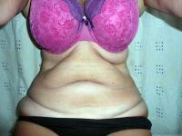 Tummy tuck with liposuction before and after image