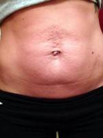 Types of tummy tuck incisions before photo