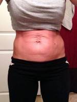 Types of tummy tuck incisions image