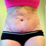 Mini tummy tuck pictures before and after Atlanta GA top plastic surgeons photos