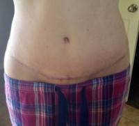 Mini tummy tuck pictures before and after Atlanta Georgia cosmetic surgeons pics