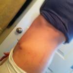 Mini tummy tuck pictures before and after Dallas top best surgeons images