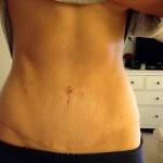 Mini tummy tuck pictures before and after Dallas top plastic surgeons pictures