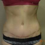 Mini tummy tuck pictures before and after Florida top best cosmetic surgeons
