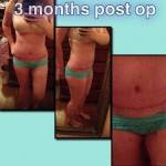 Mini tummy tuck pictures before and after Georgia plastic surgeons