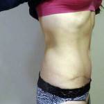 Mini tummy tuck pictures before and after Houston TX best cosmetic surgeons images