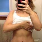 Mini tummy tuck pictures before and after Houston Texas plastic surgeons pictures
