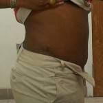 Mini tummy tuck pictures before and after Houston surgeons pics