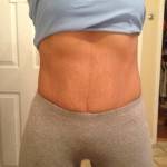 Mini tummy tuck pictures before and after Houston top best surgeons shapshots