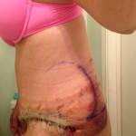 Mini tummy tuck pictures before and after Indianapolis cosmetic surgeons shapshots