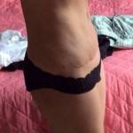 Mini tummy tuck pictures before and after Las Vegas top best cosmetic surgeons pictures