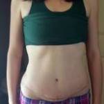 Mini tummy tuck pictures before and after Mexico best cosmetic surgeons images